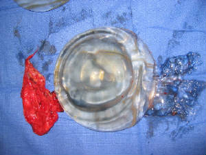 Ruptured Silicone Breast Implant